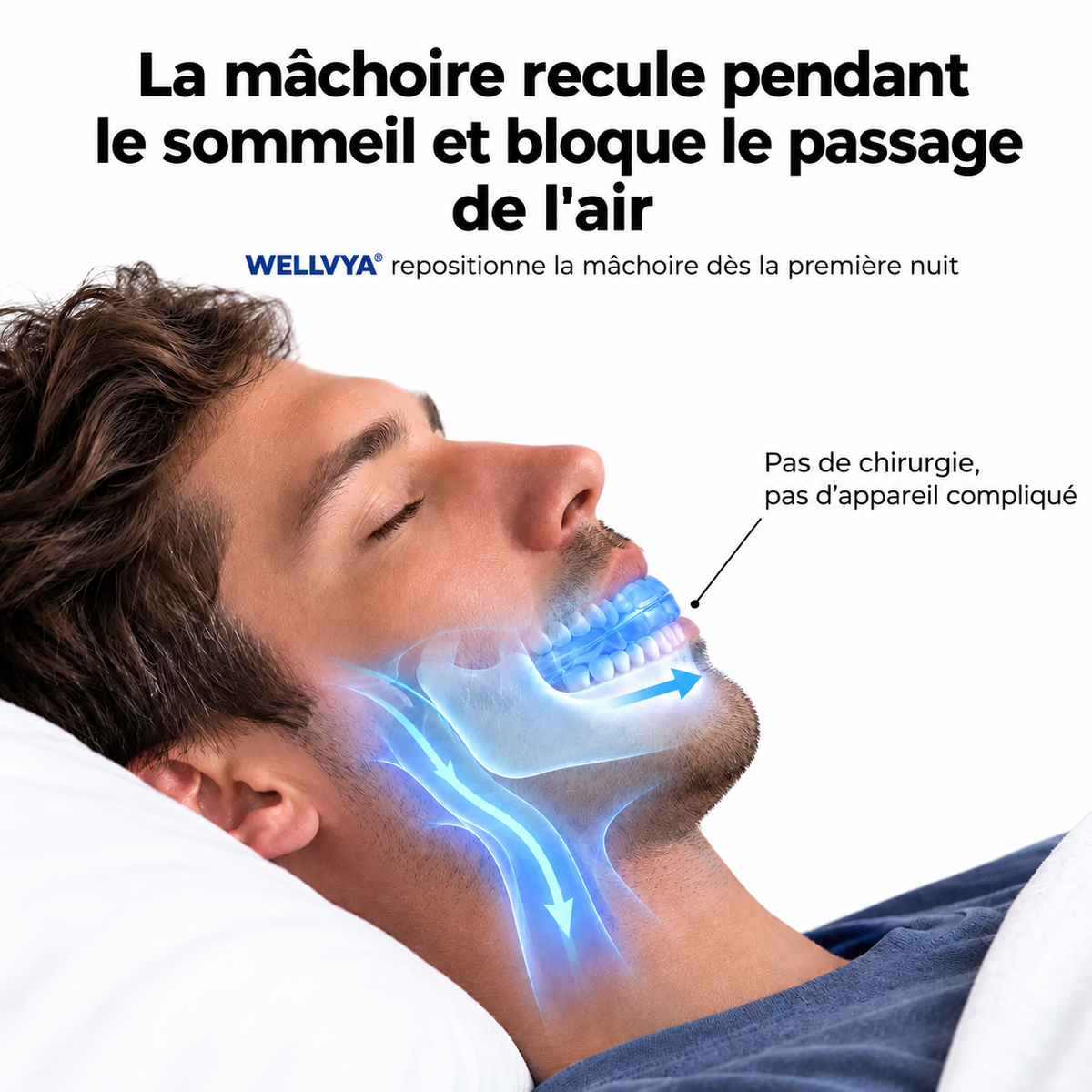 Gouttière anti-ronflement